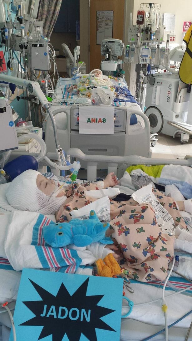 jadon anais conjoined twins separated
