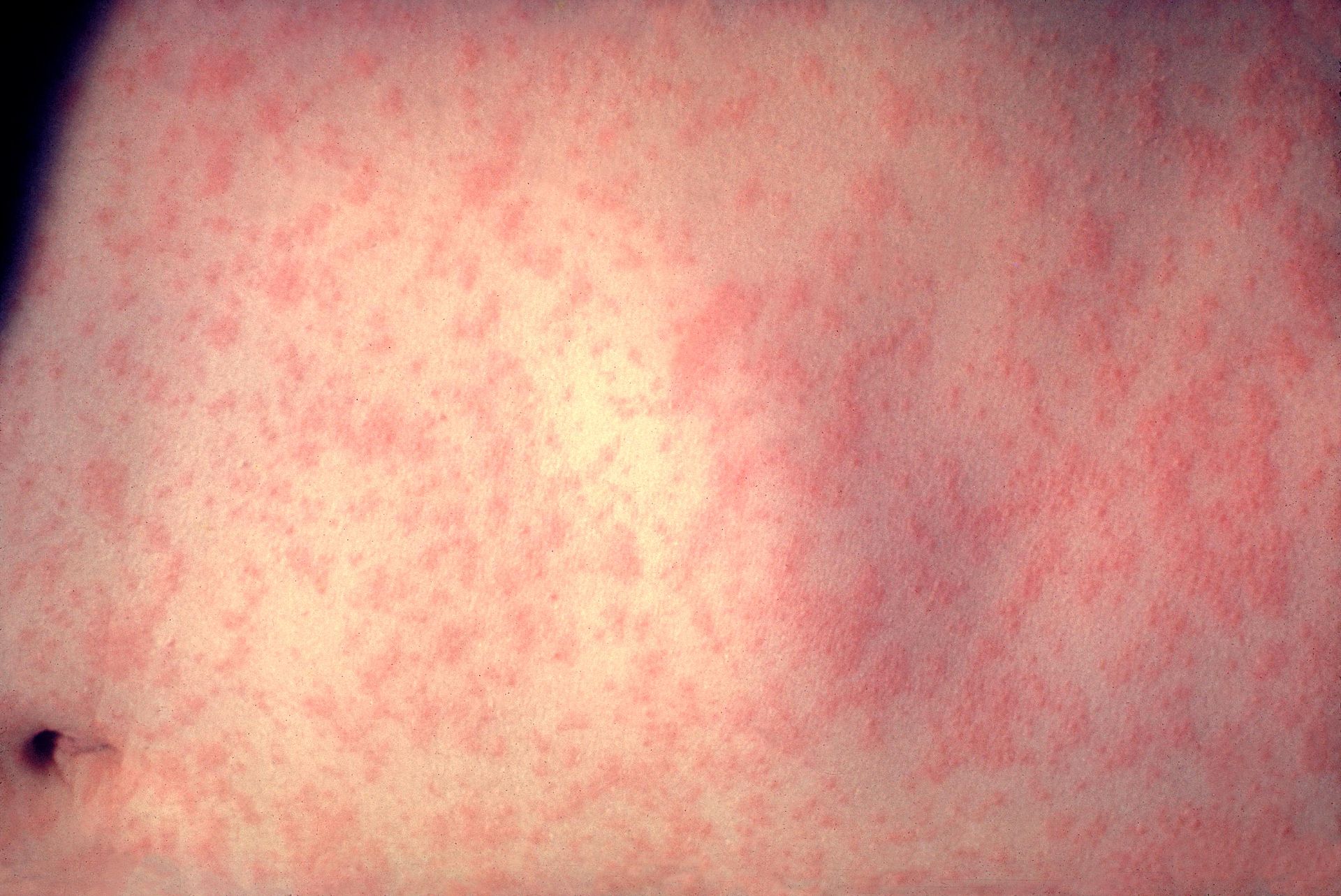 A typical measles rash