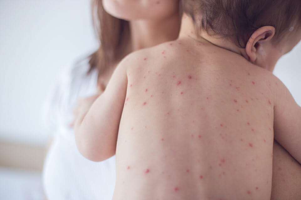 Parents urged to watch children for measles symptoms after following school student diagnosis