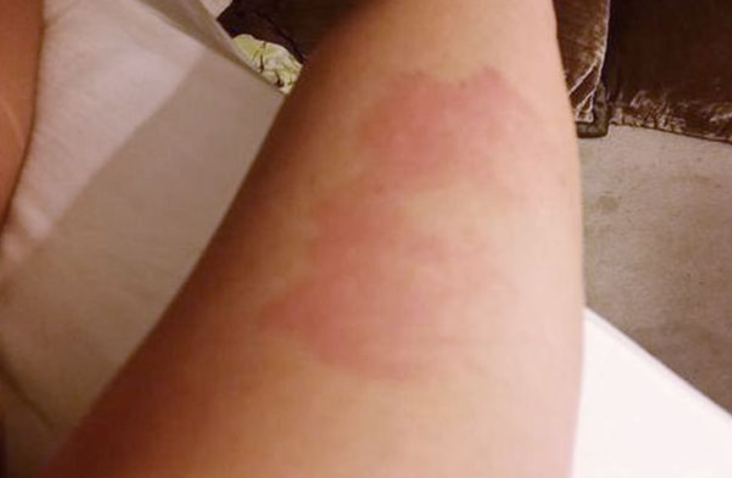 Peanut allergy rash - jennifer Ellison
