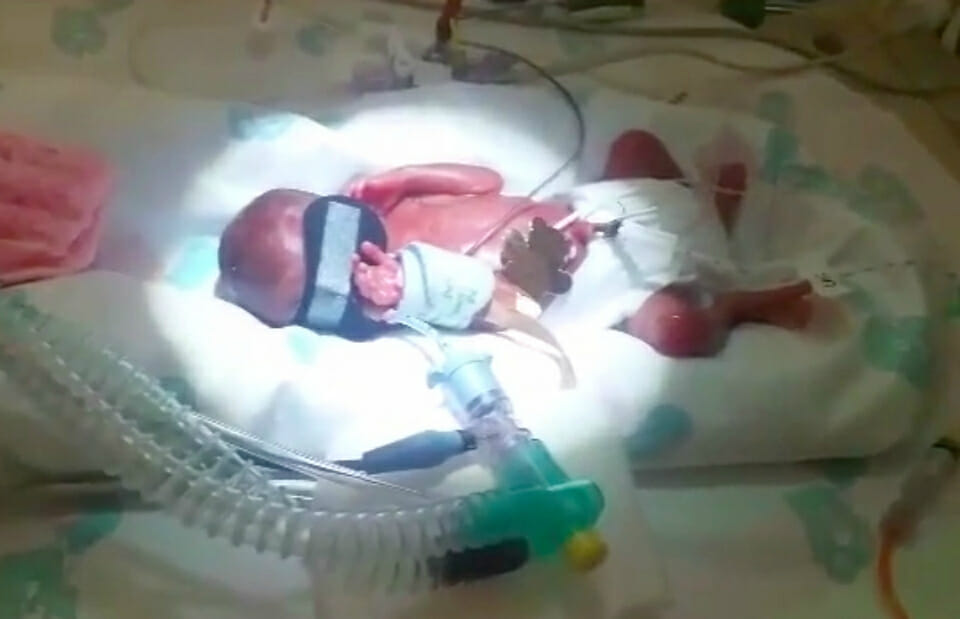 Baby born at 23 weeks proved doctors wrong Preamature Maebh NICU